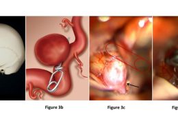 Accidente cerebrovascular (ACV): cómo reconocerlo y actuar a tiempo