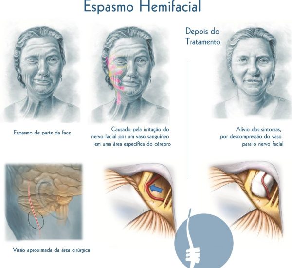 espasmo-hemifacial-dor-na-coluna-completo